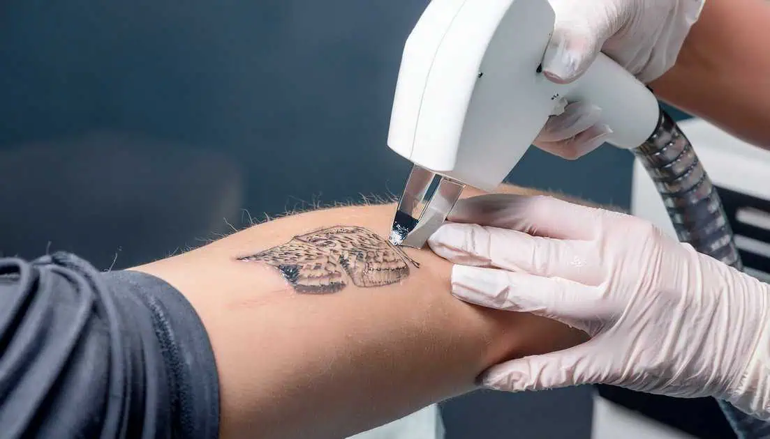 Laser Tattoo Removal in Malden, MA by Revive Medical