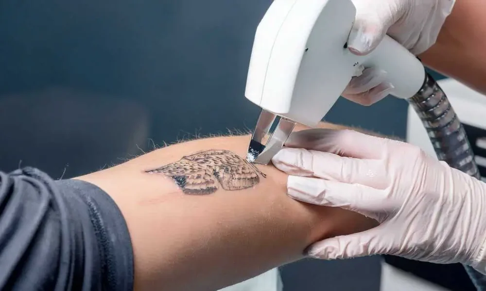 Laser Tattoo Removal in Malden, MA by Revive Medical